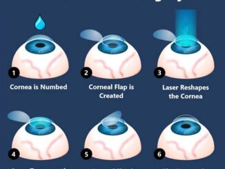 Explaining The Cost Components Of Lasik Eye Surgery