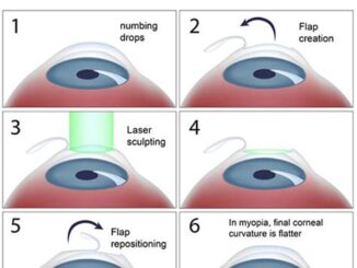 Exploring Low-Cost Lasik Eye Surgery Options