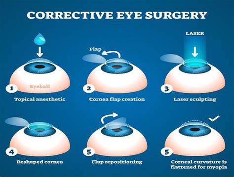 Lasik Eye Surgery Cost: What You Need To Know