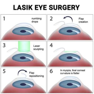 Understanding Lasik Eye Surgery Cost