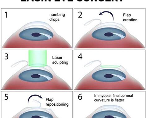 Understanding Lasik Eye Surgery Cost