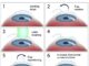 Understanding Lasik Eye Surgery Cost