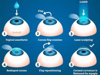 What Is The Cost Of Lasik Eye Surgery In Different States?