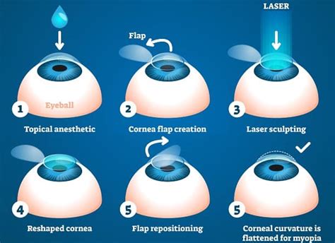 What Is The Cost Of Lasik Eye Surgery In Different States?